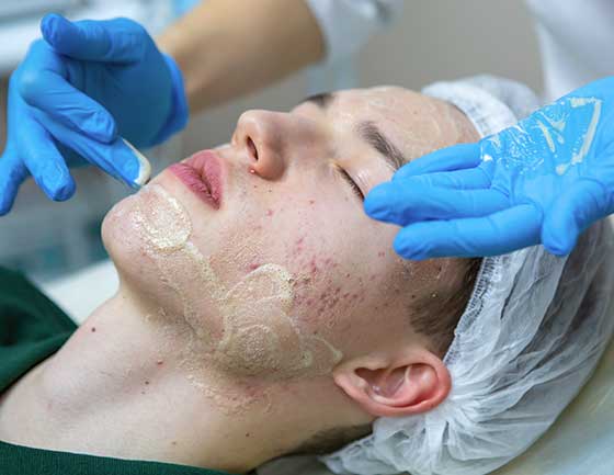 limpieza facial para acné